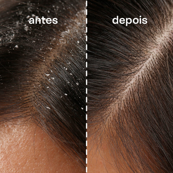 shampoo anticaspa para cabelos oleosos